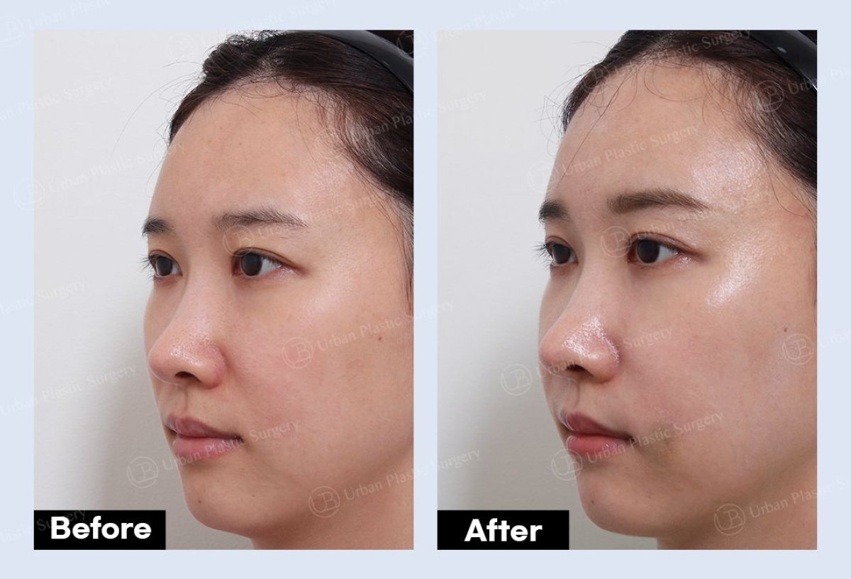 نتائج شد الوجه المصغر قبل وبعد في URBAN Plastic Surgery، تجديد شباب الوجه