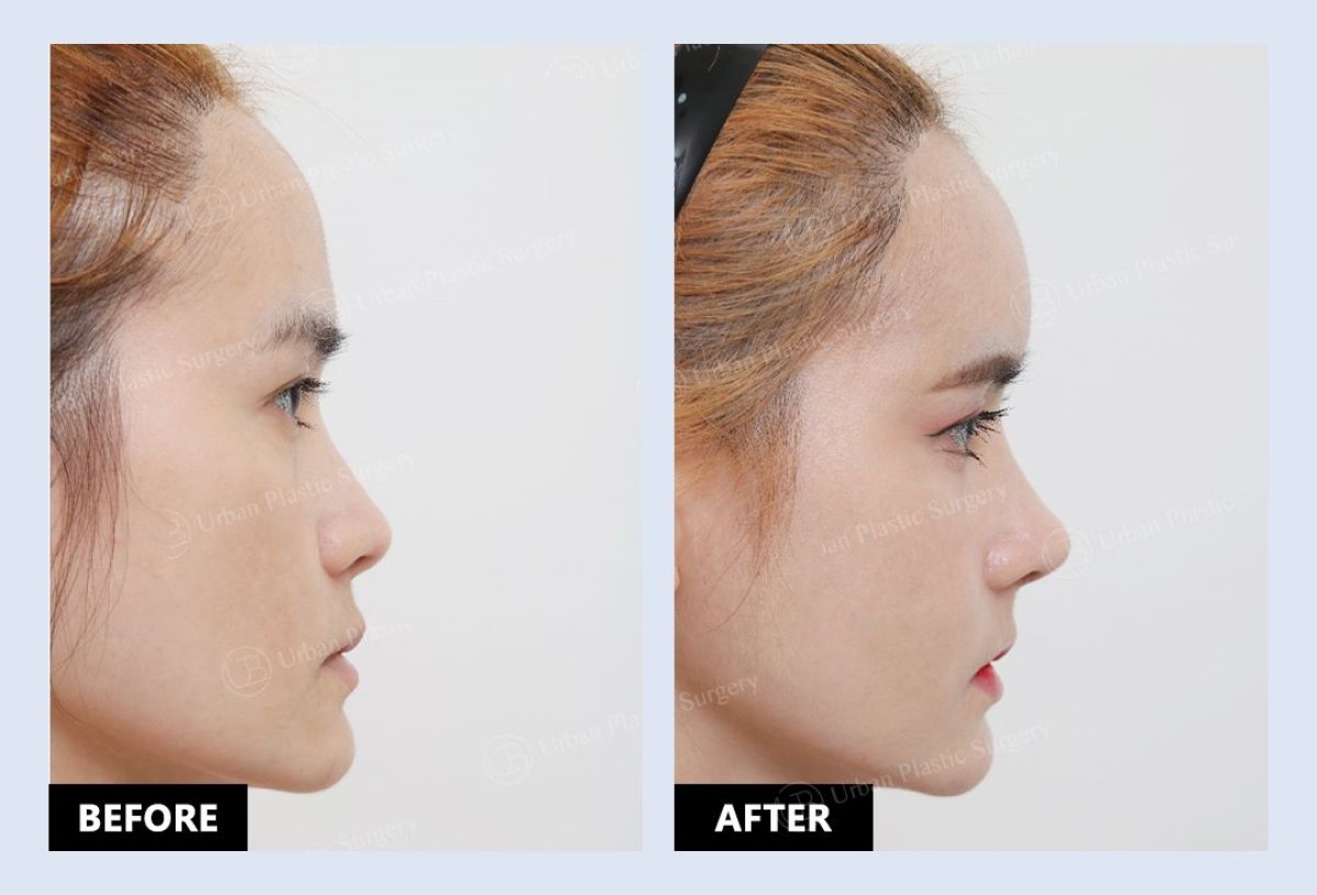 Before and after mini facelift results at URBAN Plastic Surgery, visible facial contour improvement