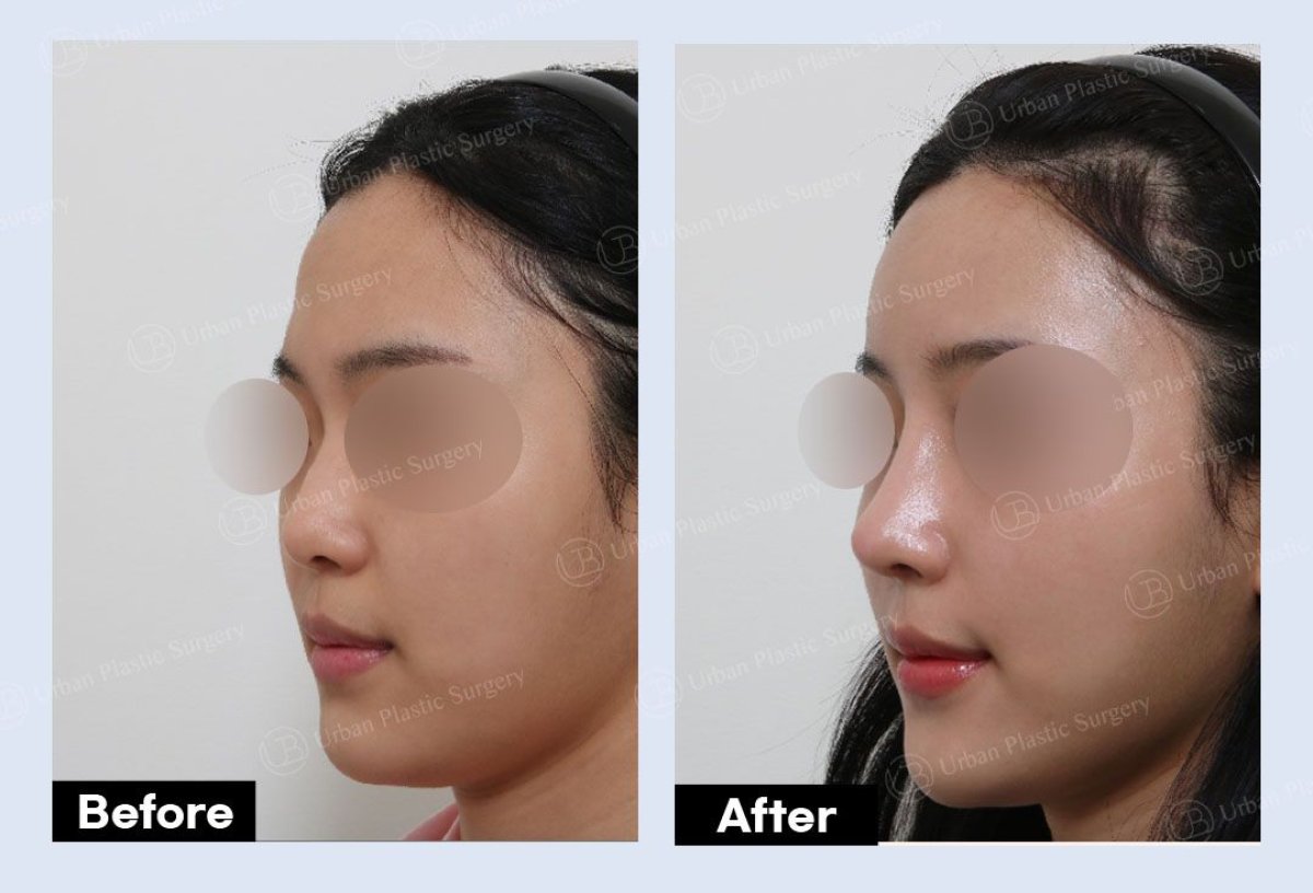 Résultats mini lifting visage avant/après chez URBAN Plastic Surgery – contour raffermi