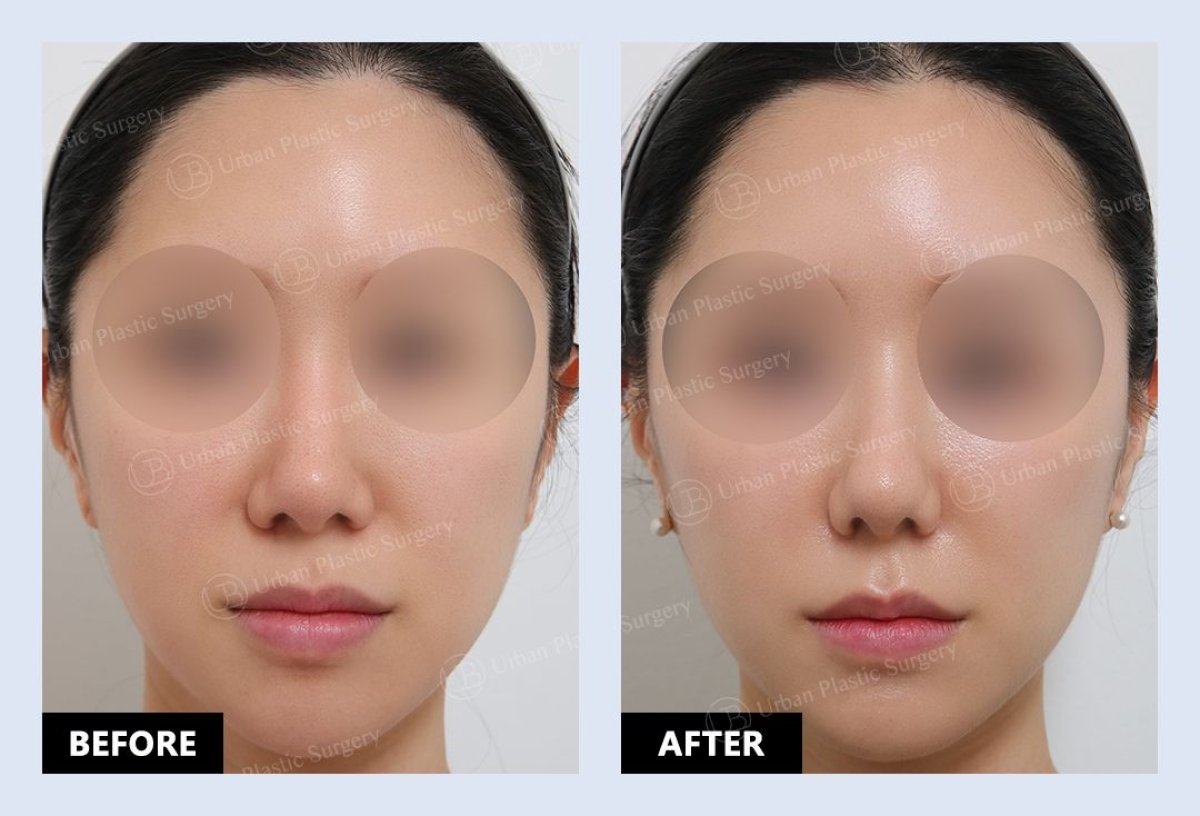 Before and after alarplasty results at URBAN Plastic Surgery, nose reshaping improvement