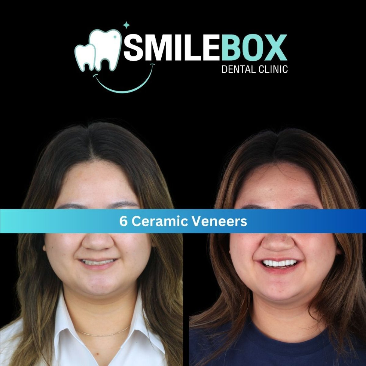 Before and after results of 6 ceramic veneers at SmileBox Dental Clinic - Thonglor, Sukhumvit