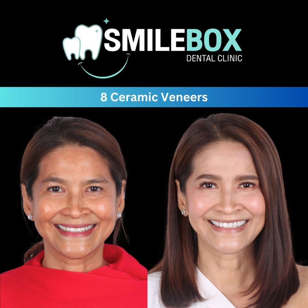 نتائج قبل وبعد 8 قشور خزفية في SmileBox Dental Clinic - فرع ثونجلور، سوكومفيت