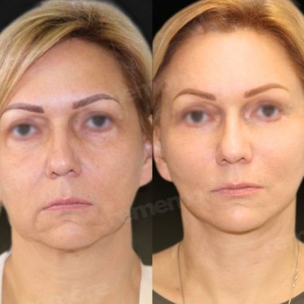 Endoscopic facelift before and after results at Memorial Şişli Hospital, facial rejuvenation