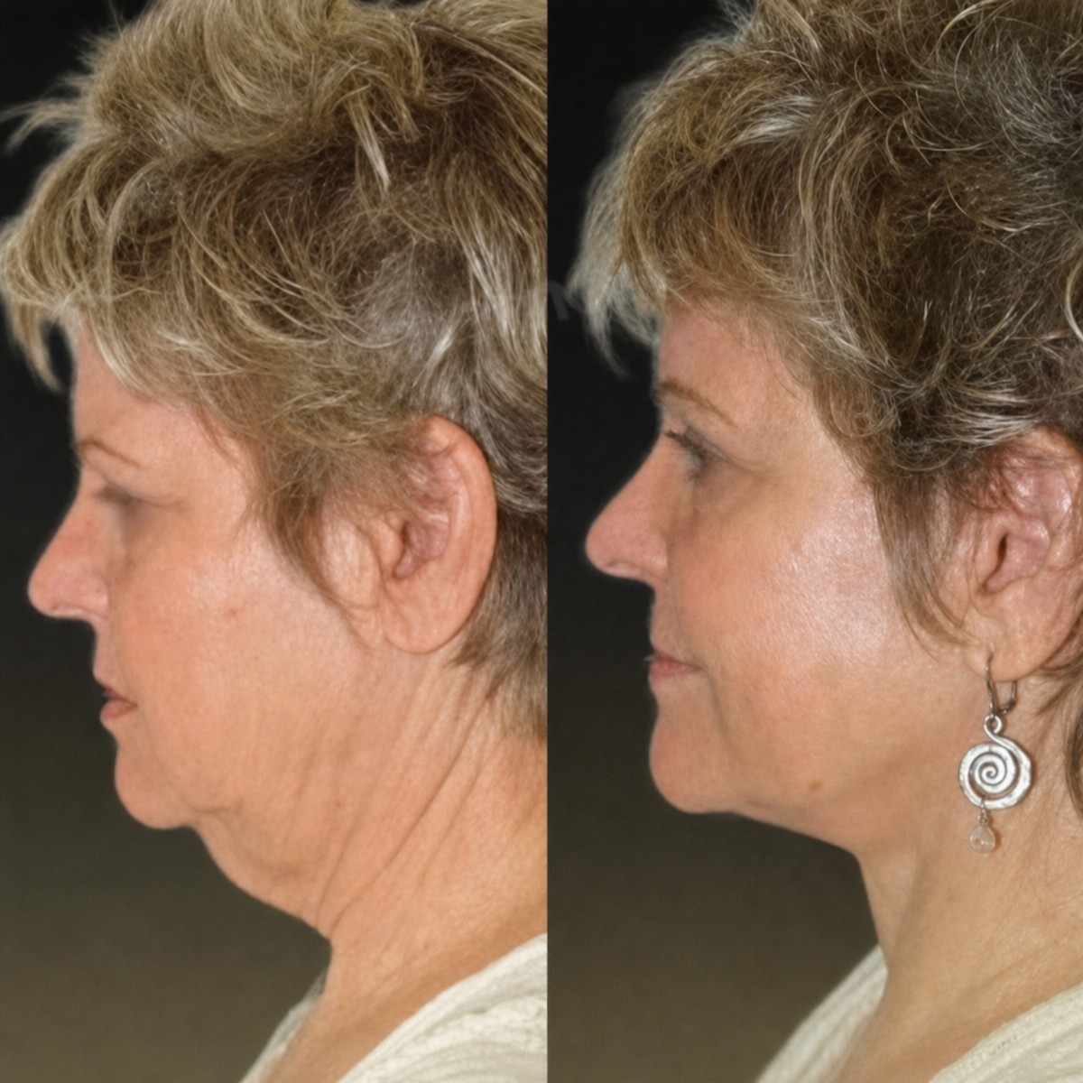 Before and after endoscopic facelift results at Memorial Şişli Hospital, visible neck lift
