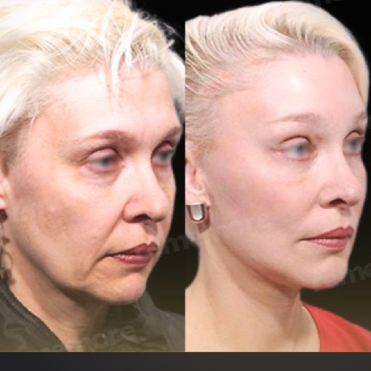 Before and after endoscopic facelift results at Memorial Şişli Hospital, facial rejuvenation