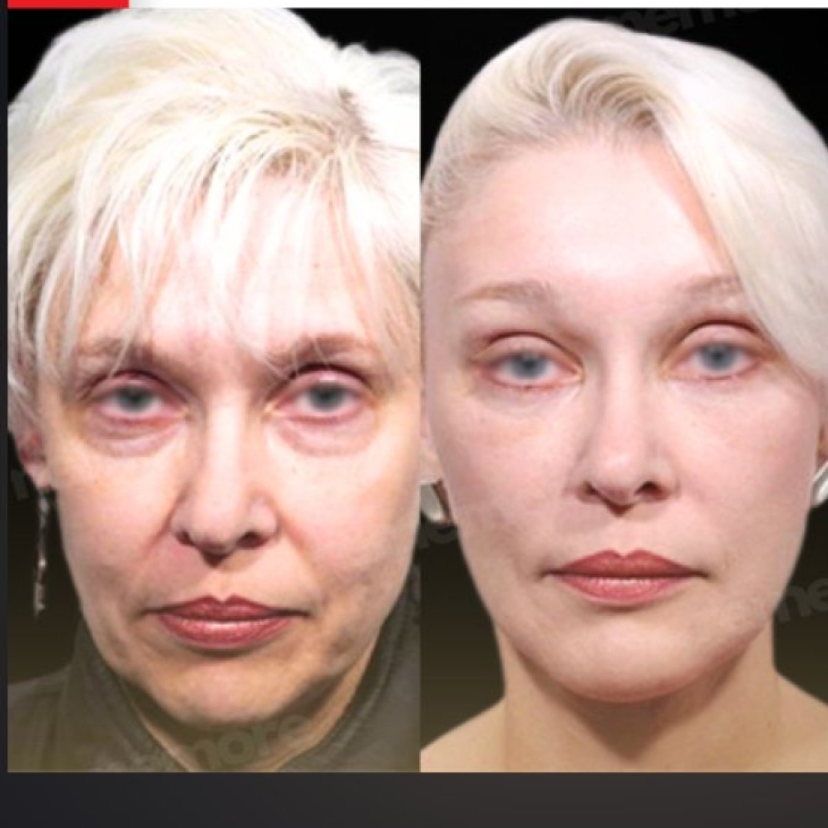 Before and after endoscopic facelift results at Memorial Şişli Hospital, facial rejuvenation