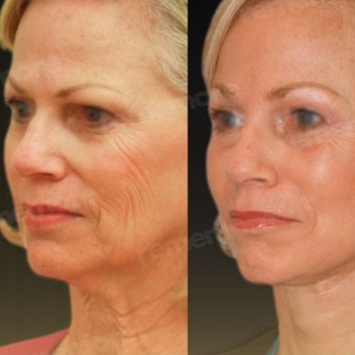 Before and after endoscopic facelift results at Memorial Şişli Hospital, smoother facial skin