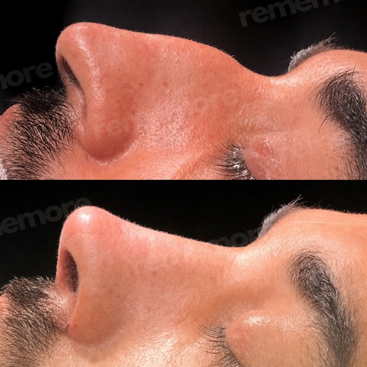 Before and after tip rhinoplasty results at Memorial Şişli Hospital, refined nose shape