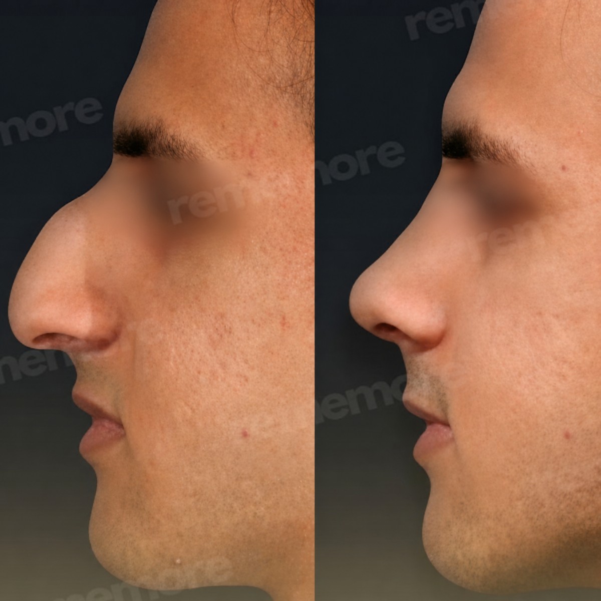 Resultado de rinoplastia de punta antes y después en Memorial Şişli Hospital, perfil mejorado