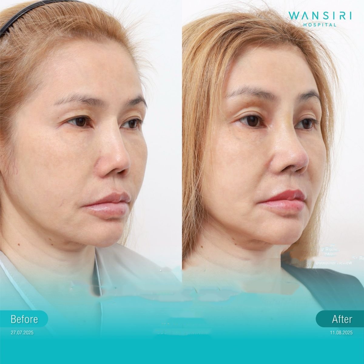 Résultats lifting endoscopique visage avant/après à Wansiri Hospital, rajeunissement visible