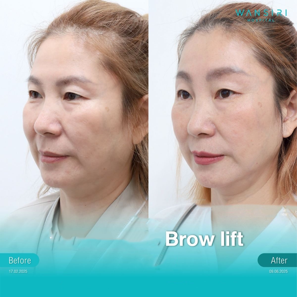 Before and after brow lift results at Wansiri Hospital, visible eyebrow and forehead lift