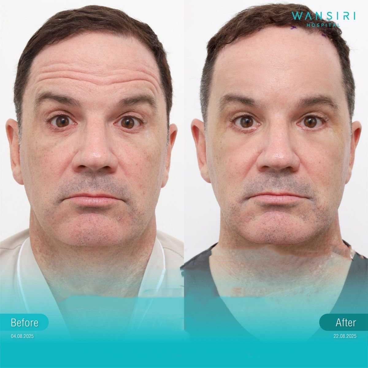 Résultats lifting endoscopique visage avant/après à Wansiri Hospital, rajeunissement visible