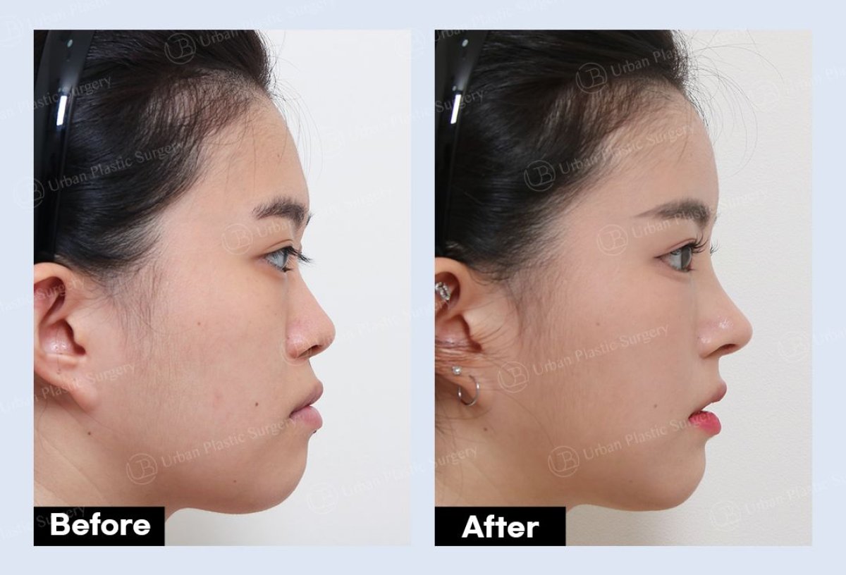Résultats avant/après rhinoplastie chez URBAN Plastic Surgery, profil du nez amélioré