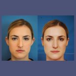 Résultats de la procédure Otoplastie (chirurgie des oreilles) par le Dr Dr Phatcharasak Kraisornphongsakul Md - Photos avant et après des patients Photos avant et après par le Dr Dr Phatcharasak Kraisornphongsakul Md