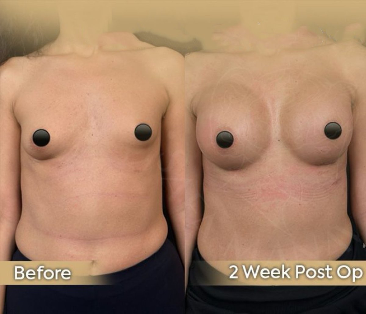 Resultados antes y después de implantes y lifting de senos en Dr. Safa Manav Clinic, 2 semanas