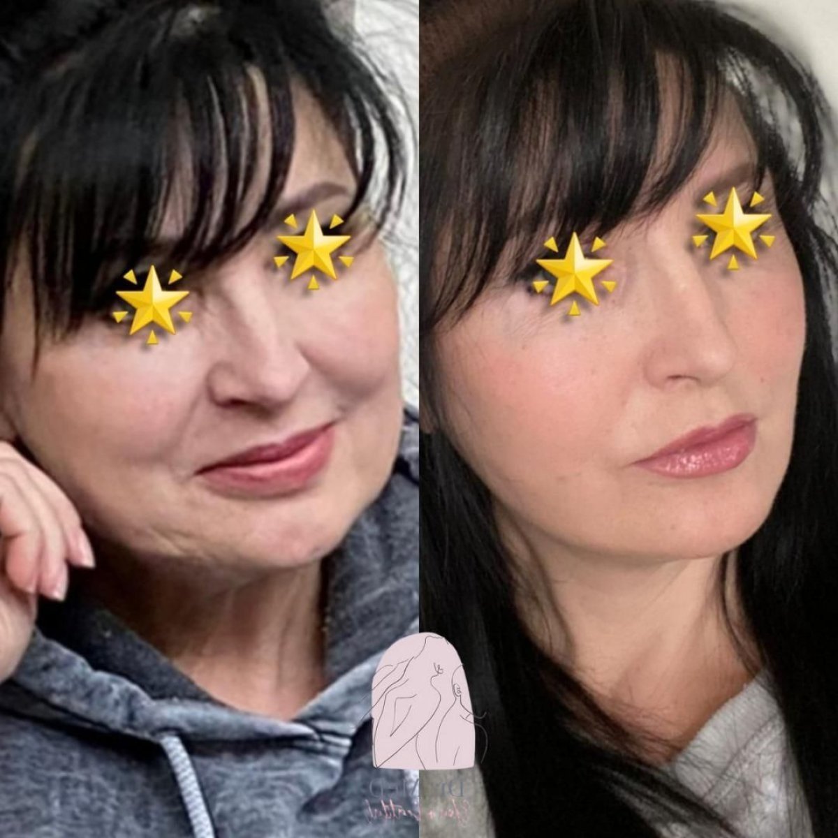 Resultados de lifting facial antes y después en Dr. MED – rejuvenecimiento visible