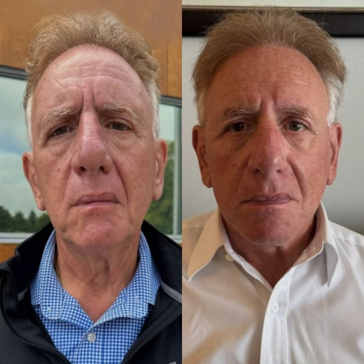 Résultats avant/après mini lifting du visage à CE International Hospital, rajeunissement visible