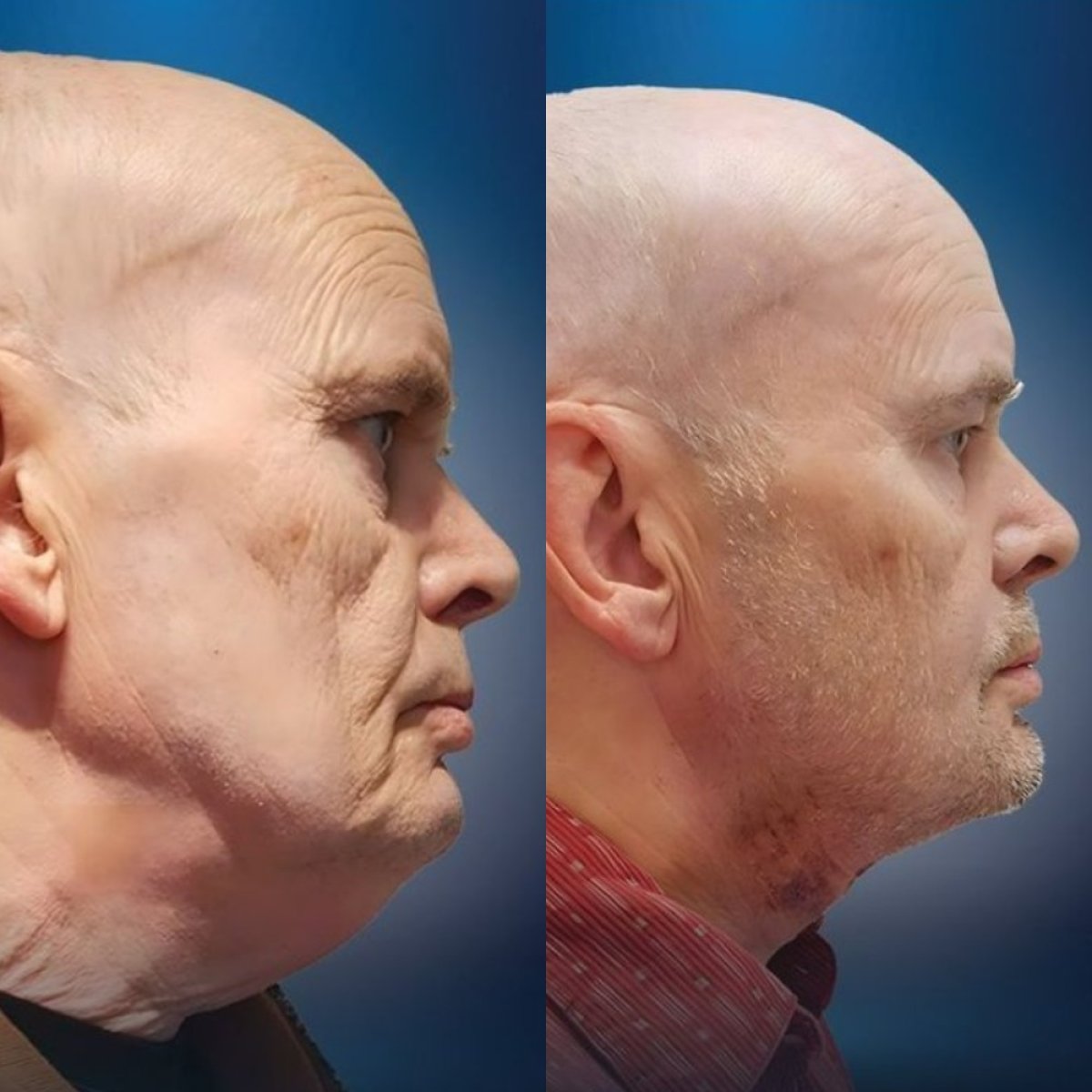 Resultados de minilifting facial antes y después en CE International Hospital, rejuvenecimiento