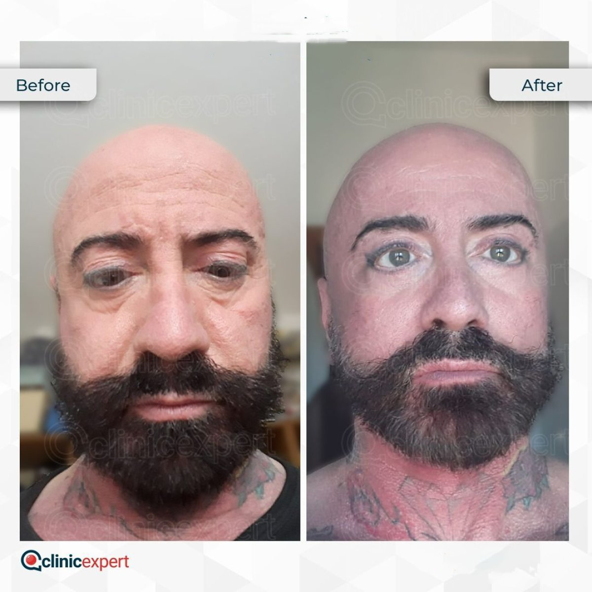 Resultados de minilifting facial antes y después en CE International Hospital, rejuvenecimiento