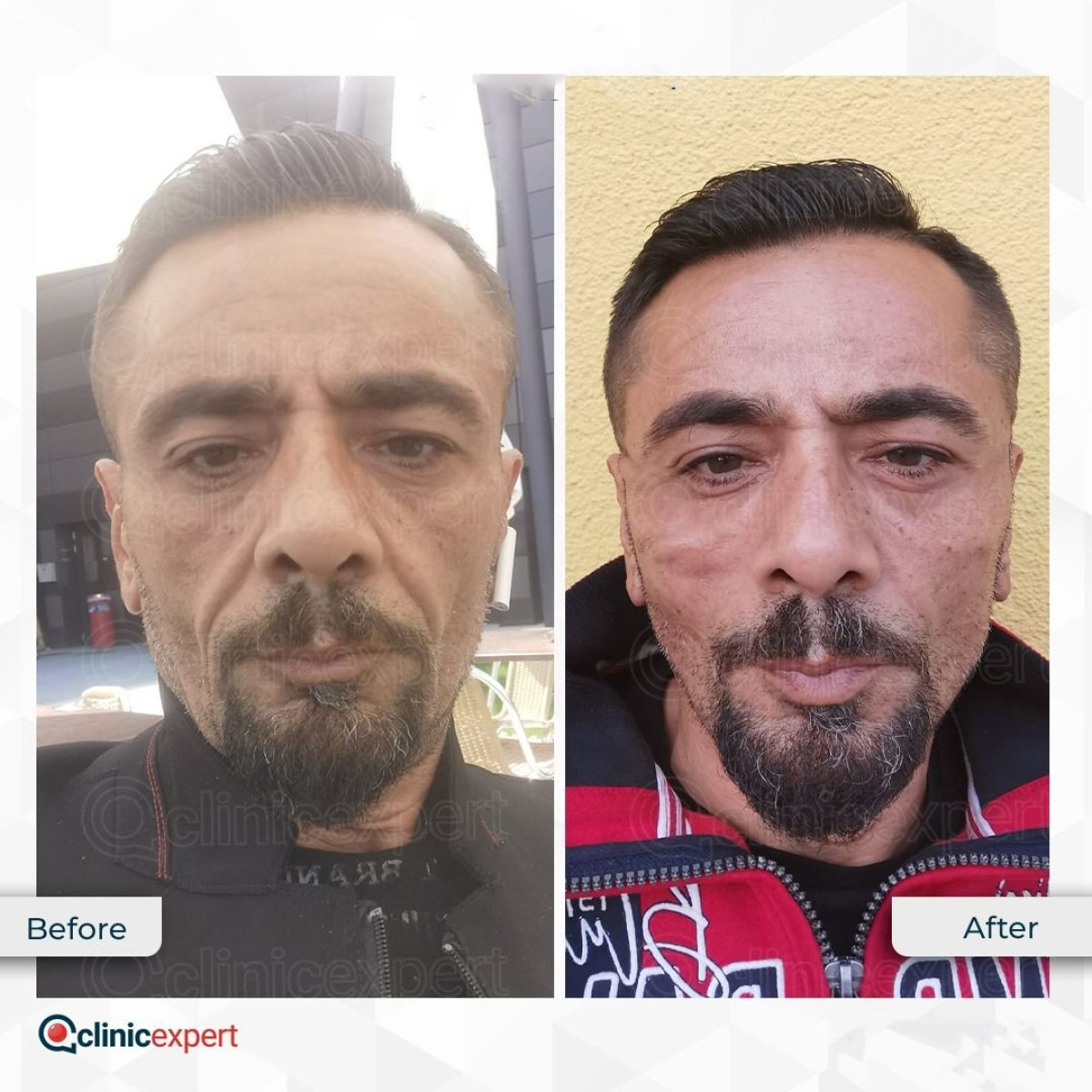 Resultados de minilifting facial antes y después en CE International Hospital, rejuvenecimiento