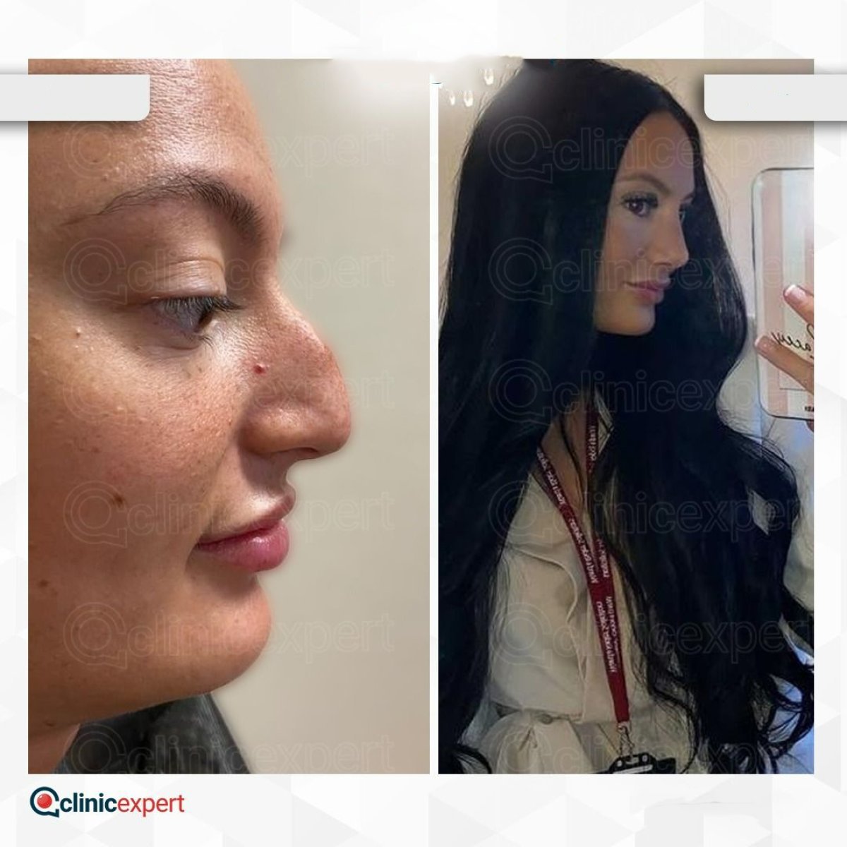 نتيجة قبل وبعد عملية تجميل الأنف التصحيحية في CE International Hospital، تحسين شكل الأنف
