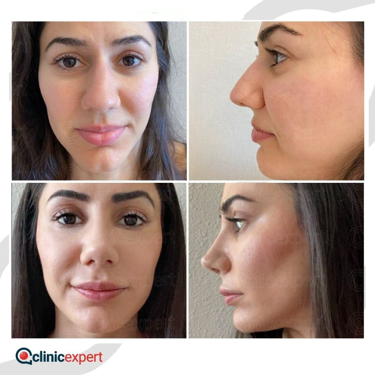Before and after revision rhinoplasty results at CE International Hospital, improved nose shape