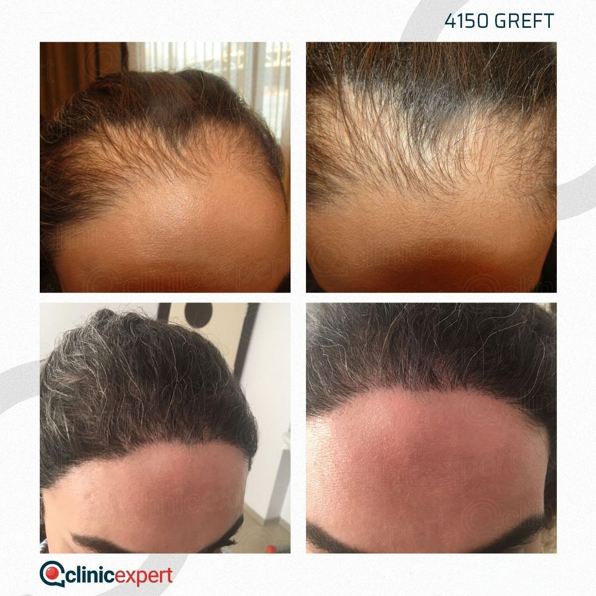 Before and after DHI hair transplant results at CE International Hospital, 4150 grafts used