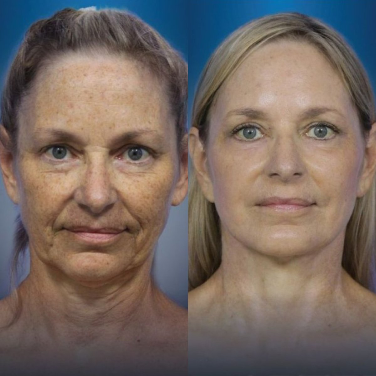 Resultados de lifting facial antes y después en CE International Hospital – rejuvenecimiento