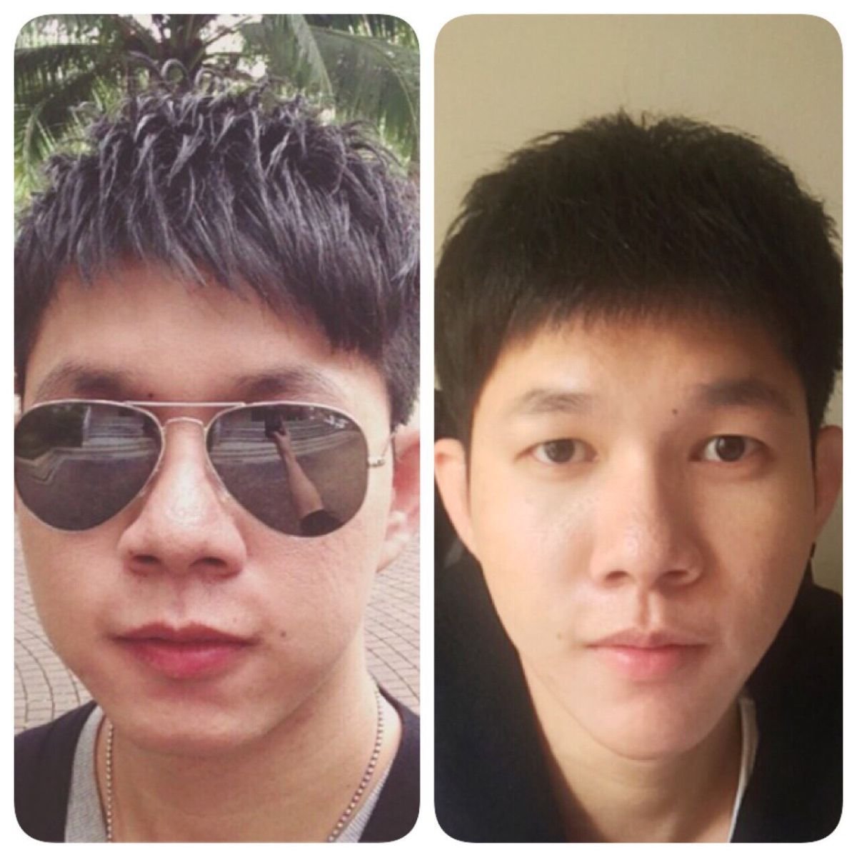 Before and after nonsurgical facelift results at Asia Cosmetic Hospital, facial rejuvenation visible