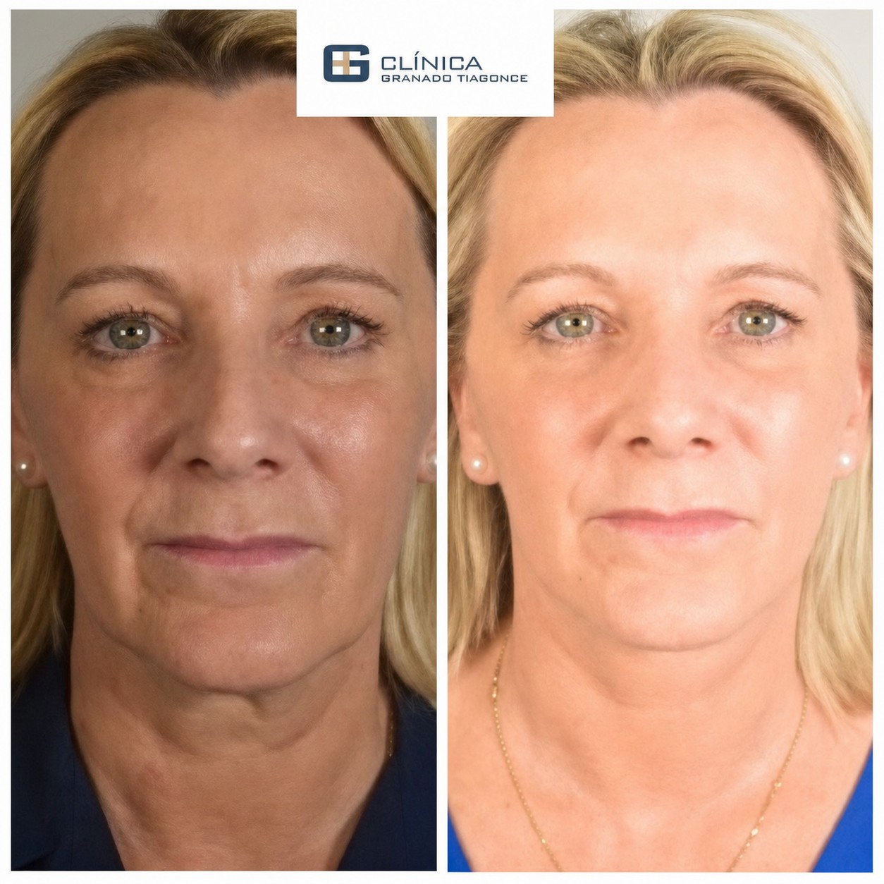 Resultados de lifting facial antes y después en Clinica Granado Tiagonce, rejuvenecimiento facial