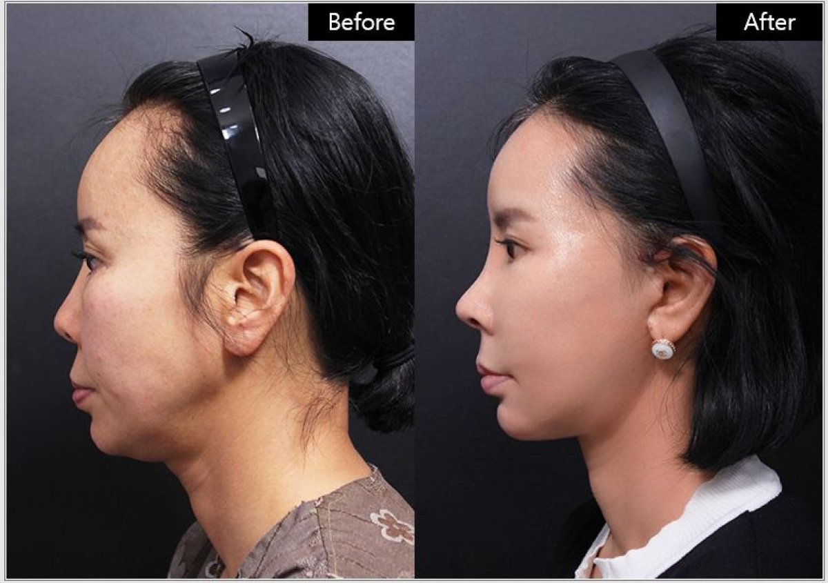 Before and after nonsurgical facelift results at VG Plastic Surgery, visible facial contour lift