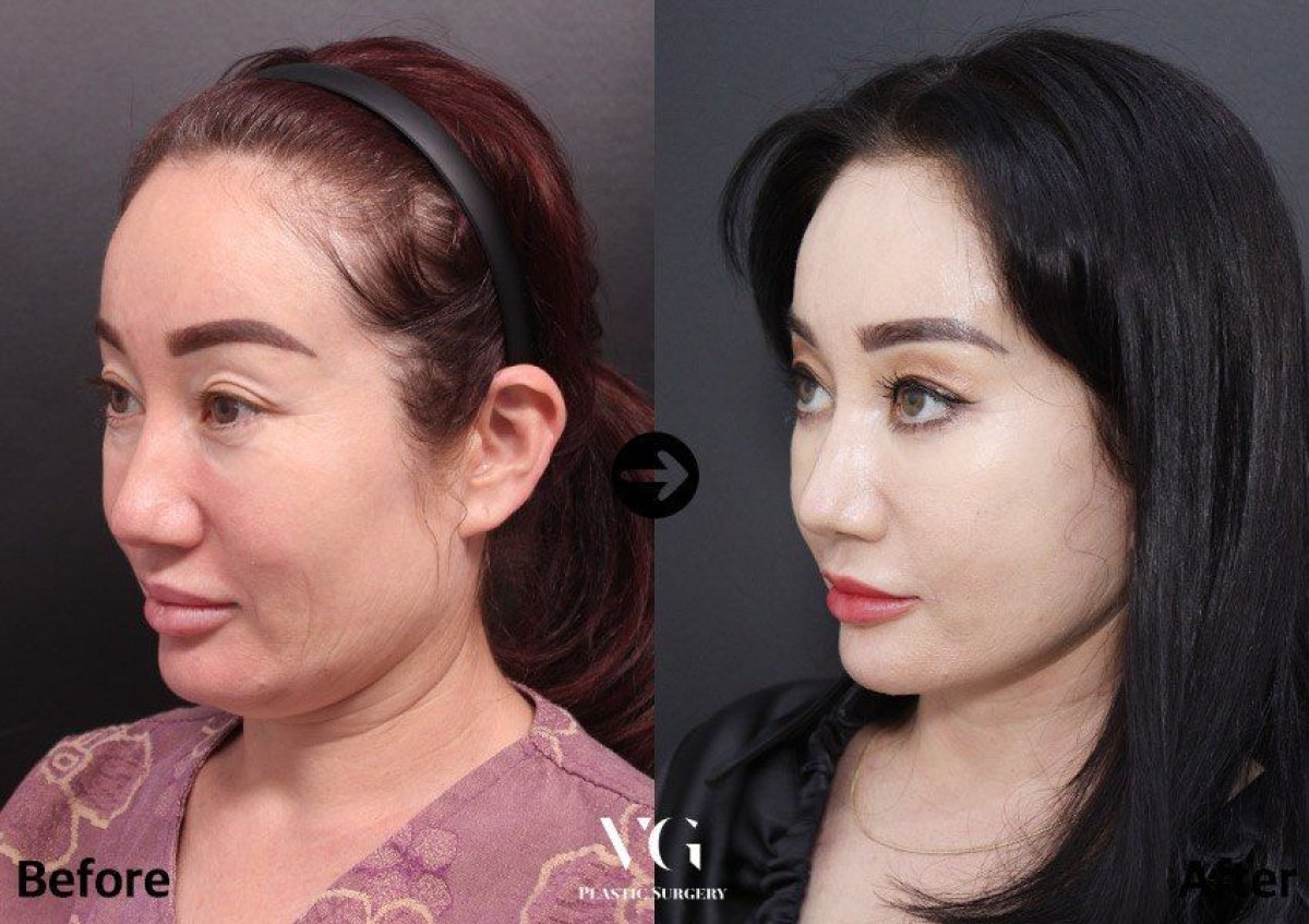 نتائج شد الوجه غير الجراحي قبل وبعد في VG Plastic Surgery، تجديد شباب الوجه