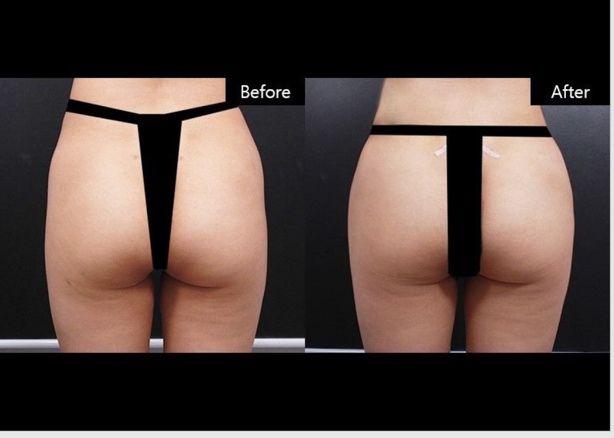 Avant et après lipofilling chez VG Plastic Surgery, contour et volume des fesses améliorés