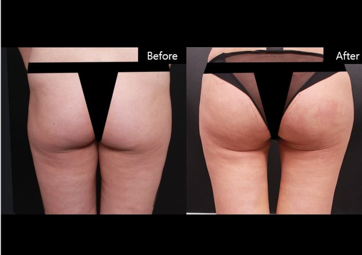 Efekty lipofillingu pośladków przed i po w VG Plastic Surgery, poprawiony kontur