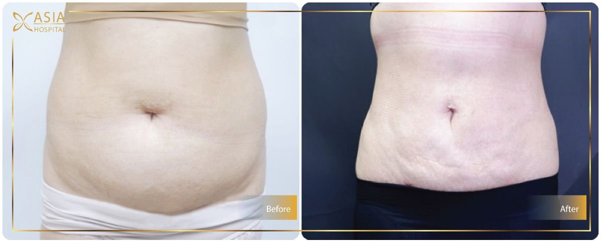 Before and after Vaser 3 areas plus tummy tuck results at Asia Cosmetic Hospital, flatter abdomen
