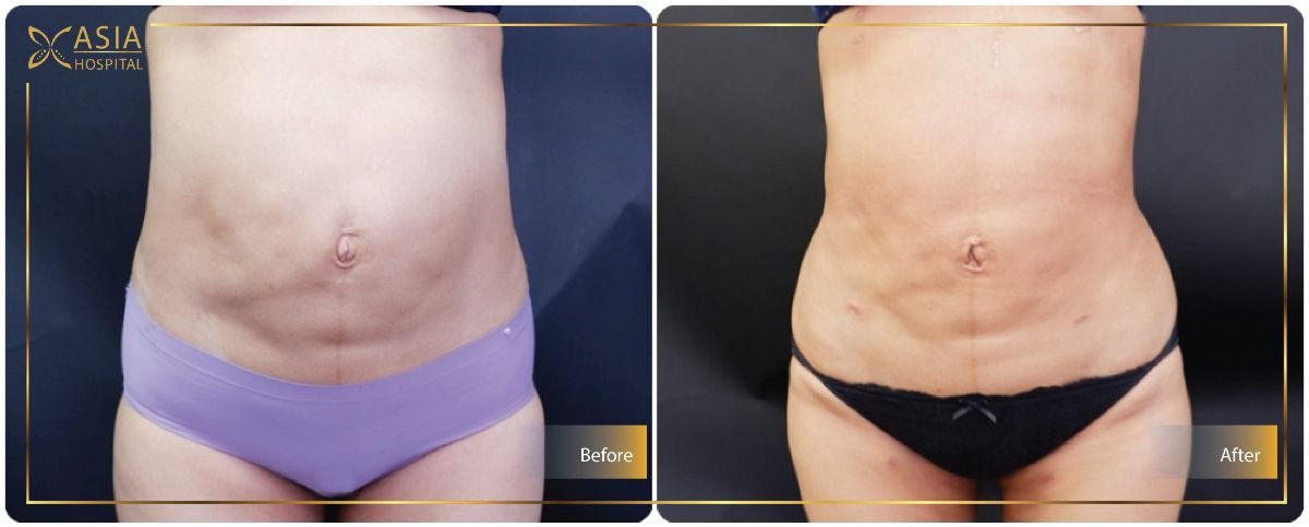 Before and after Vaser lipo 3 areas plus tummy tuck results at Asia Cosmetic Hospital