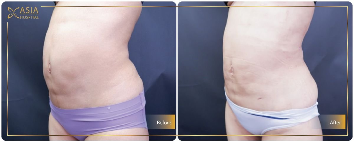 Before and after Vaser 3 areas plus tummy tuck results at Asia Cosmetic Hospital, flatter abdomen