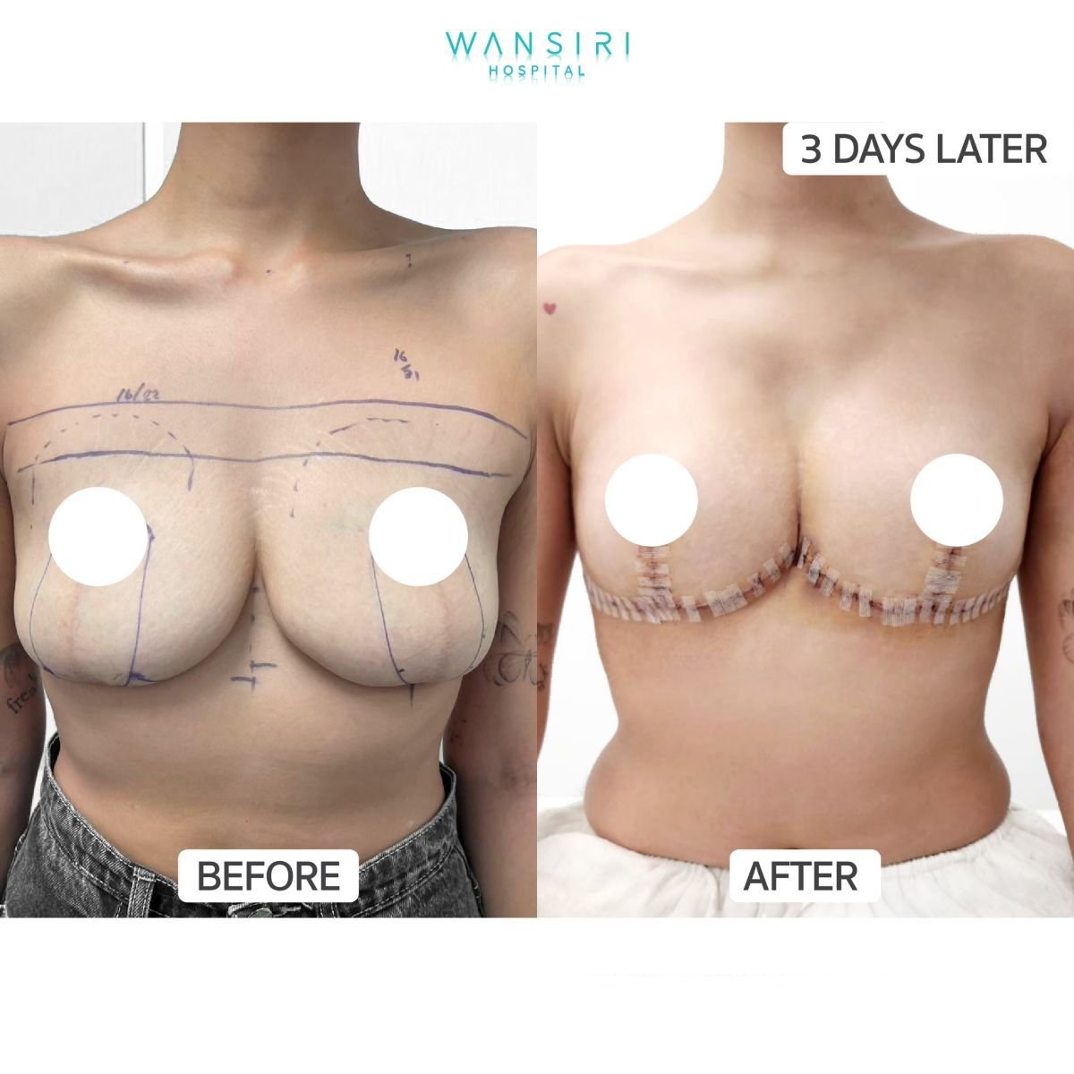 قبل وبعد عملية تجميل الأم في مستشفى وانسيري، نتائج رفع وتشكيل الثدي