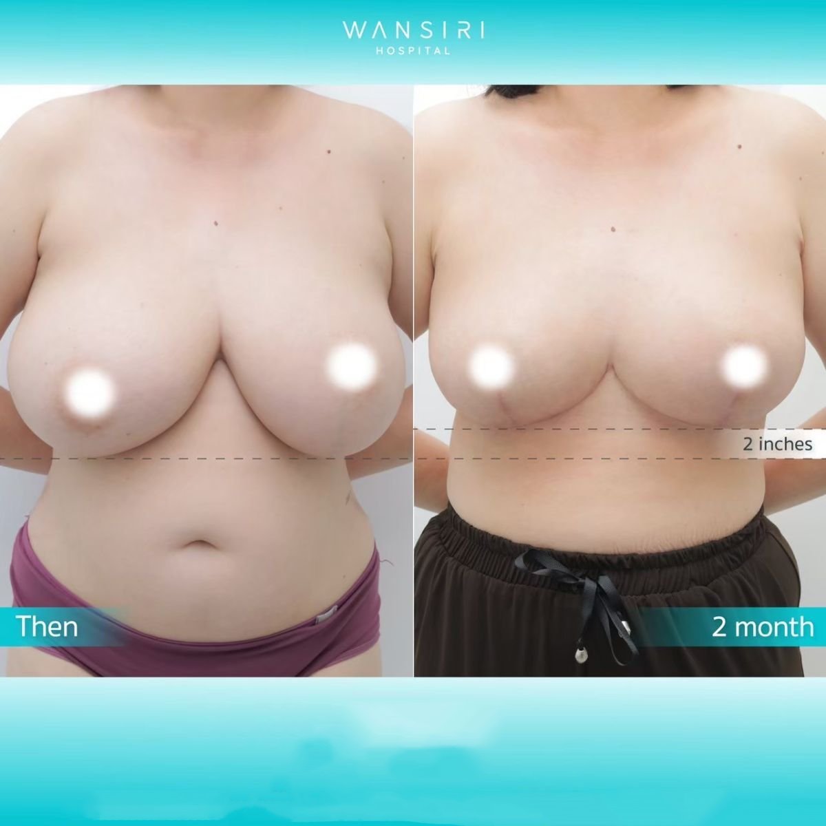 Avant/après mommy makeover à Wansiri Hospital, lifting des seins et amélioration du contour