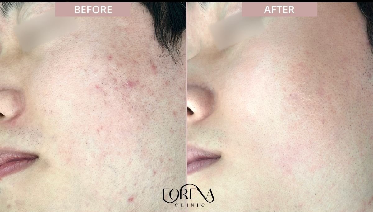 Before and after acne scar treatment results at Forena Clinic, improved skin texture and clarity