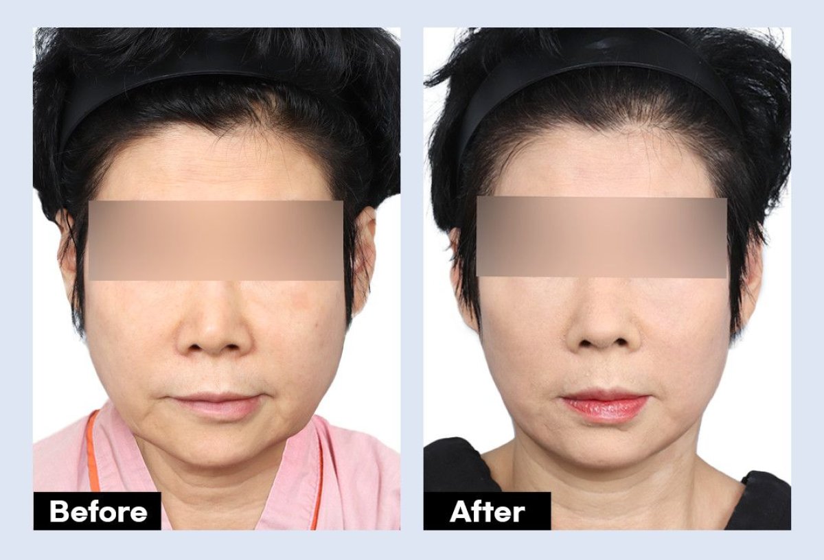 نتائج شد الوجه العميق قبل وبعد في URBAN Plastic Surgery، تجديد شباب الوجه