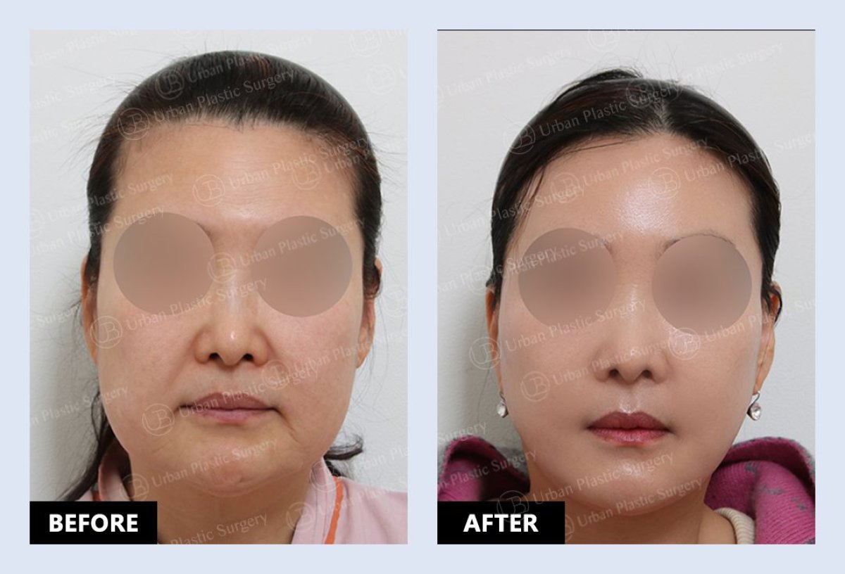 Deep Plane Facelift before and after results at URBAN Plastic Surgery – facial rejuvenation outcome