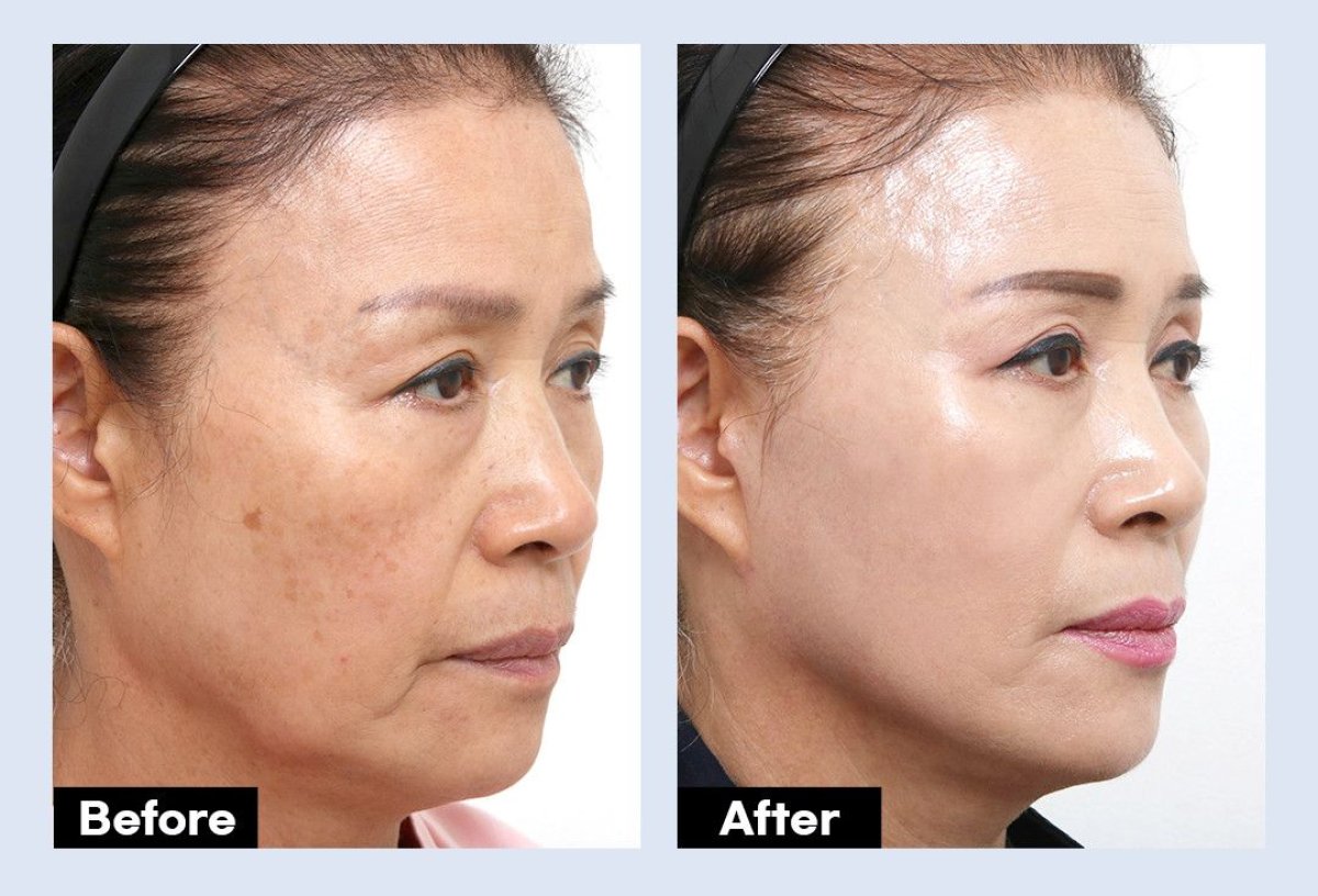 نتائج شد الوجه العميق قبل وبعد في URBAN Plastic Surgery، تجديد شباب الوجه