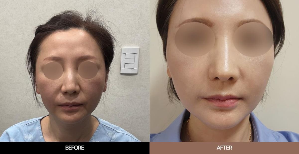 نتائج قبل وبعد شد الوجه العميق في URBAN Plastic Surgery، تجديد شباب الوجه