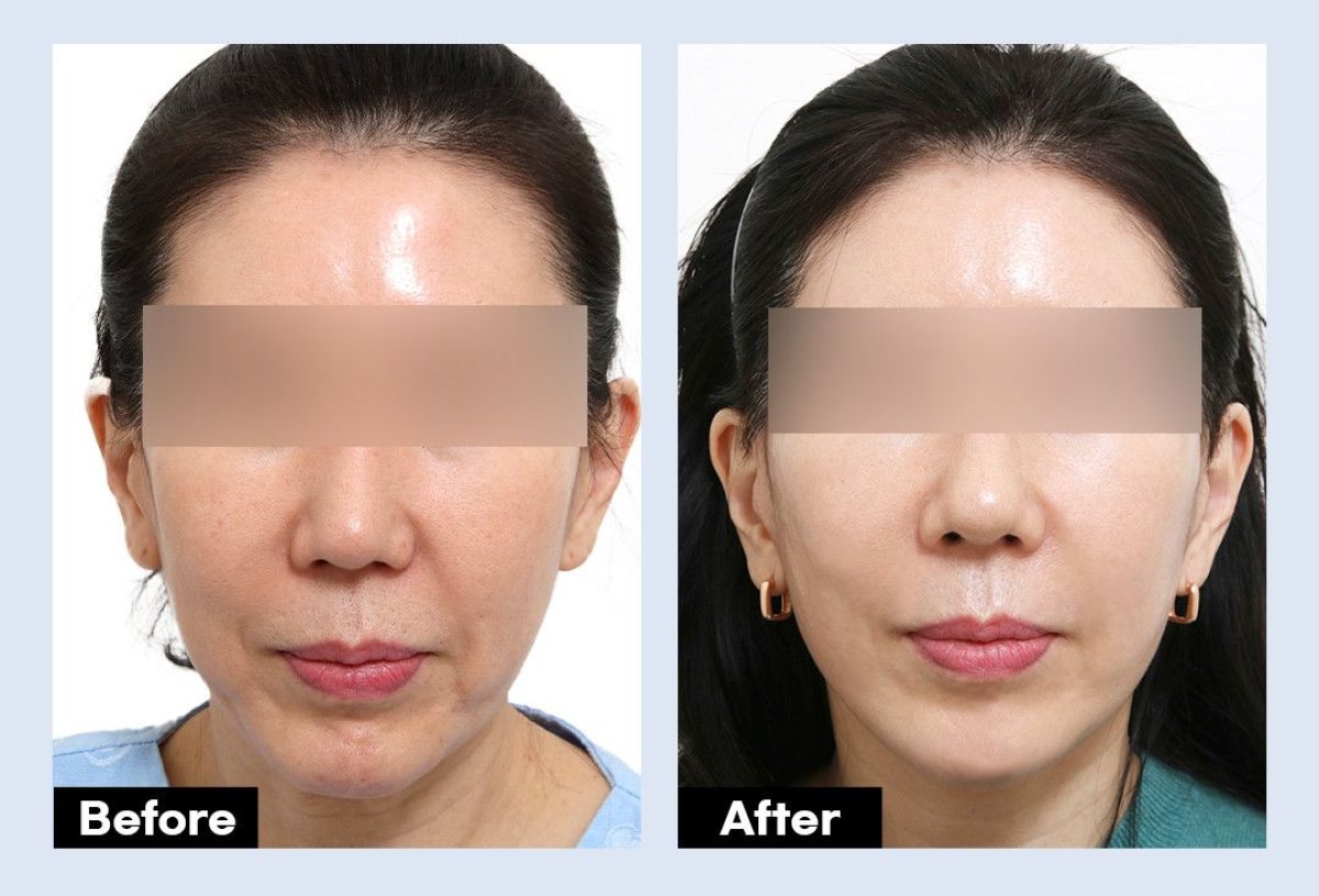 نتائج قبل وبعد شد الوجه العميق في URBAN Plastic Surgery – تجديد شباب الوجه