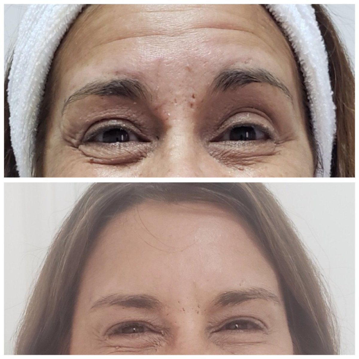 Avant et après injection de fillers à Clinica Granado Tiagonce, réduction des rides des yeux