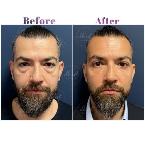 Upper & Lower Blepharoplasty - All Included - photo 4