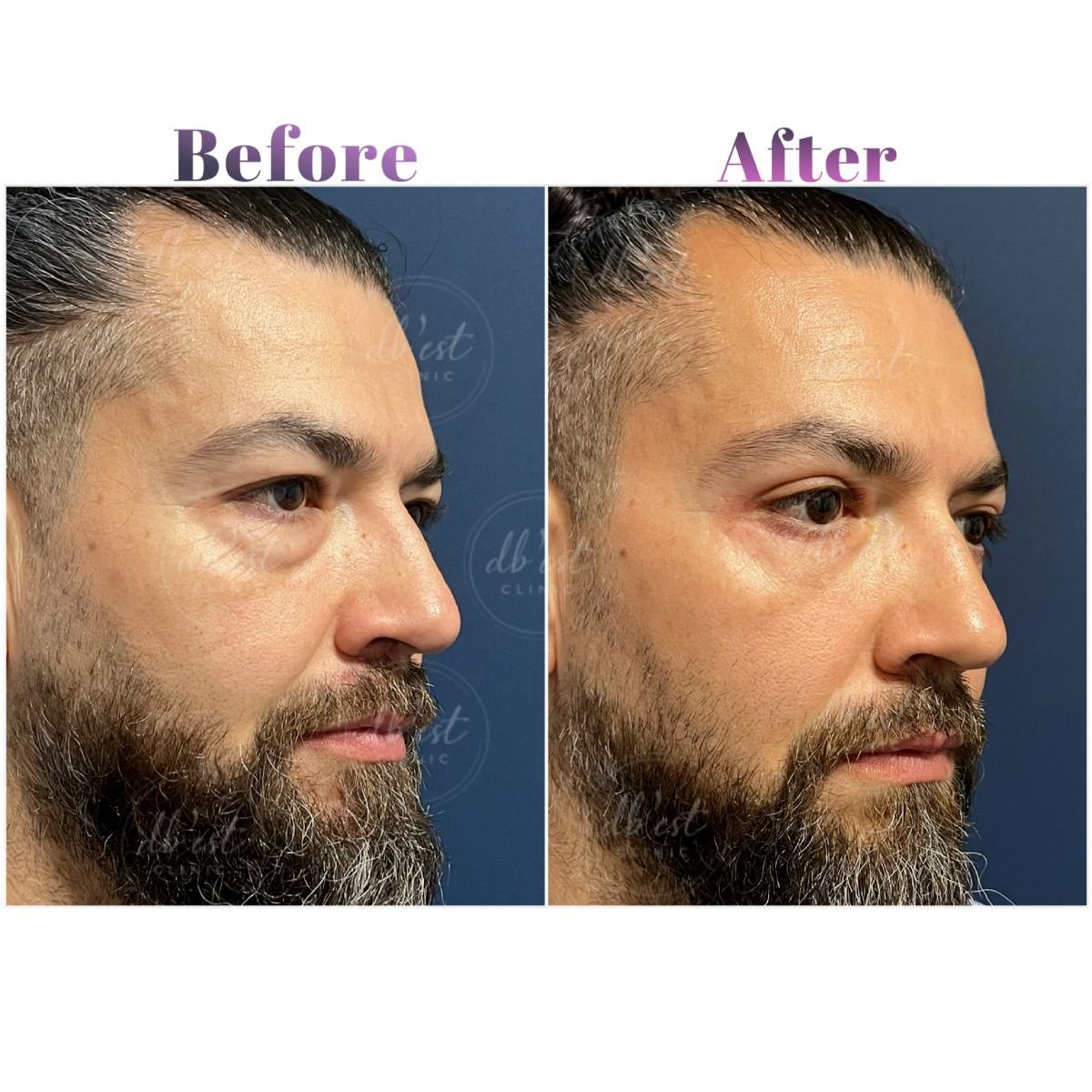 Résultats avant/après blépharoplastie à Db'est Clinic – poches sous les yeux réduites