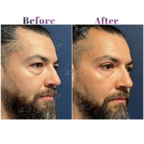 Upper & Lower Blepharoplasty - All Included