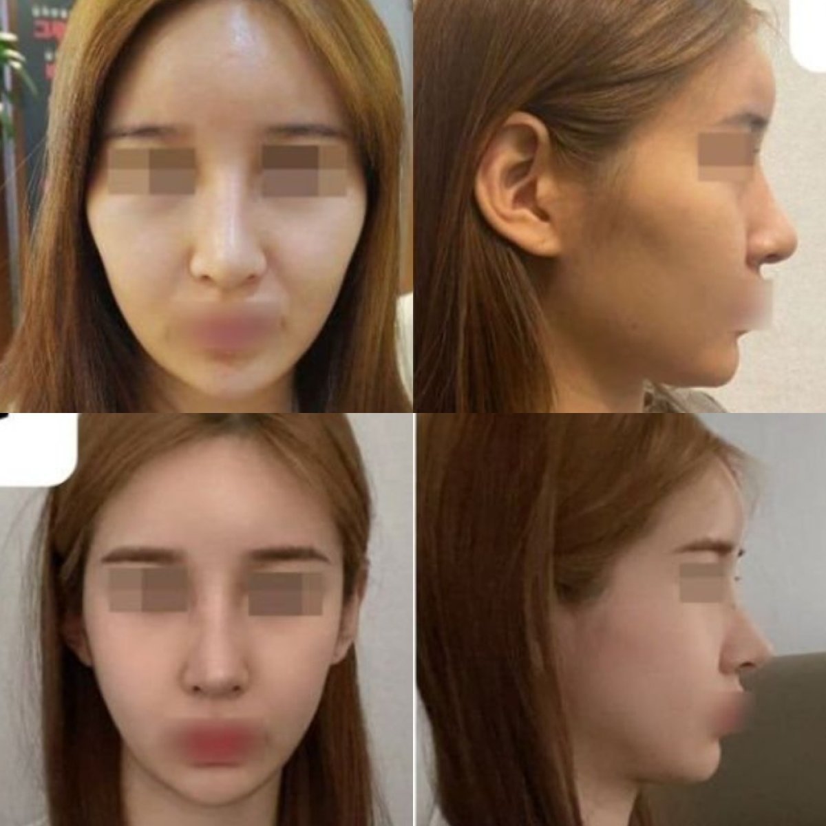 نتائج قبل وبعد تشكيل الفك في VG Plastic Surgery، تحسين ملامح الوجه والتناظر